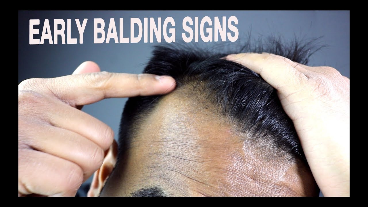 Early baldness signs and prevention