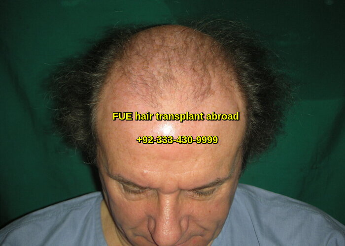 cheap fue hair transplant UK