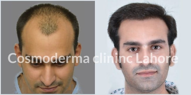 3200 grafts Fue hair restoration results 