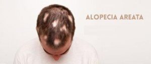 alopecia-areata-treatment specialist Lahore Pakistan