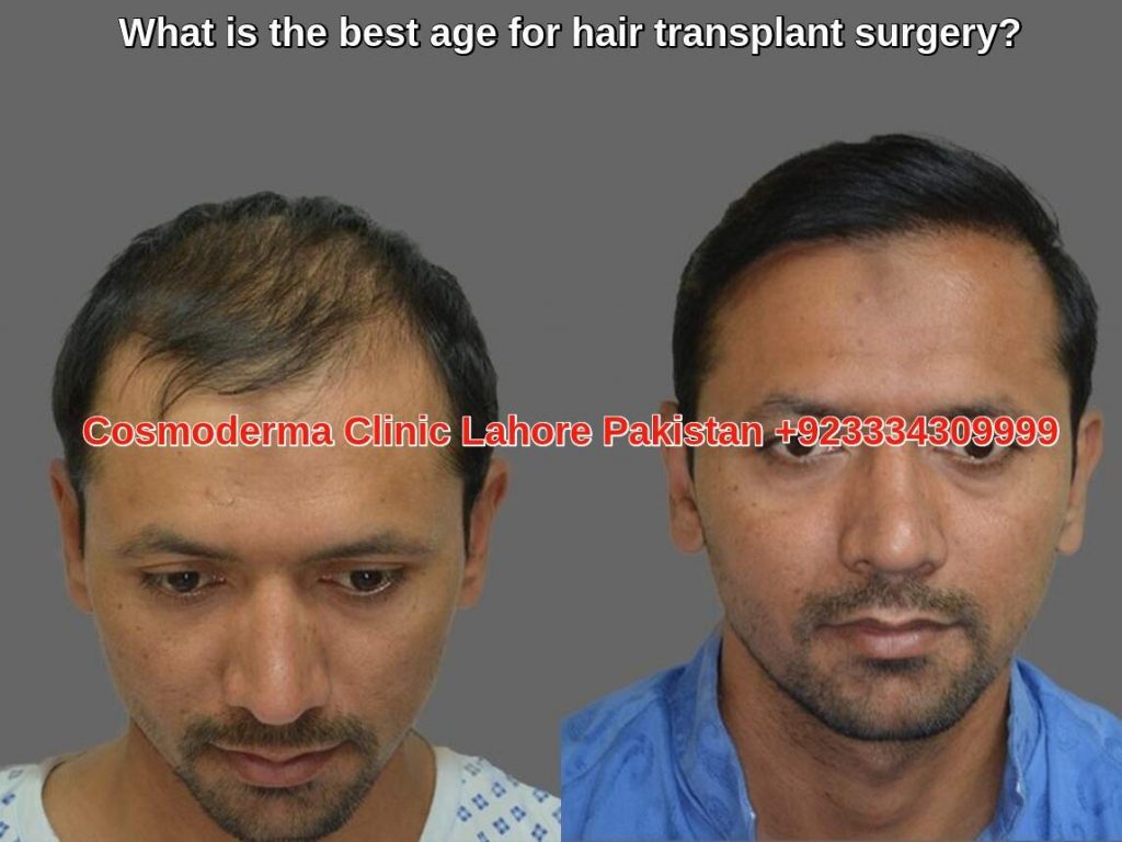 Best hair transplant results Lahore Pakistan