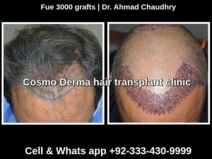 Before and one day after Fue procedure Lahore