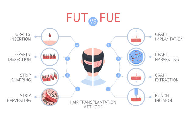 Fue-FUT hair transplant