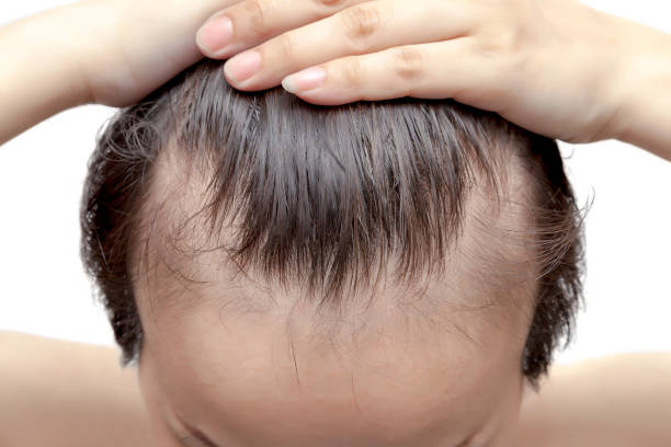 male hair loss causes