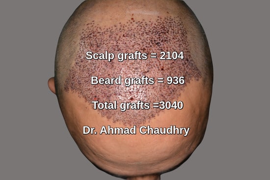 3040 grafts hair transplant photo