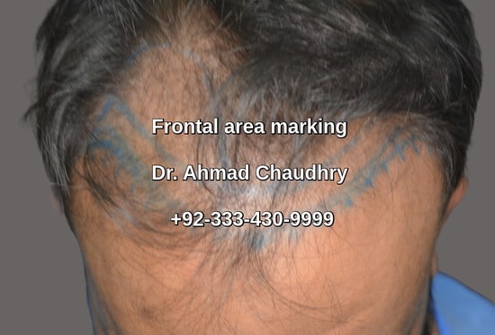 Frontal area marking hair transplant patient