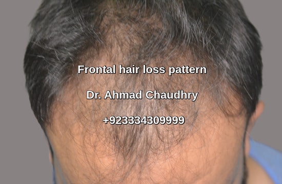 Frontal hair loss pattern Gujranwala patient