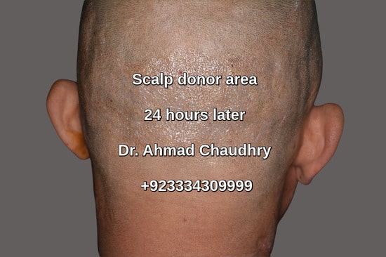 Fue scalp donor area Lahore