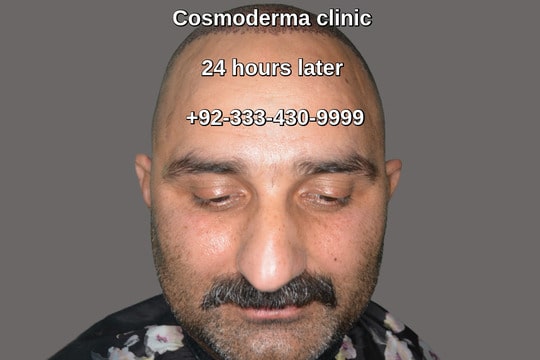 Scalp and beard grafts hair restoration clinic Lahore