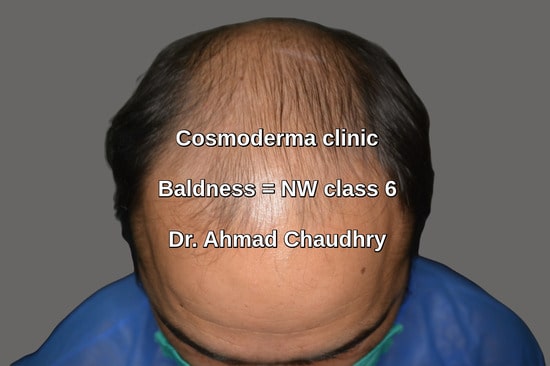 Top view before baldness treatment
