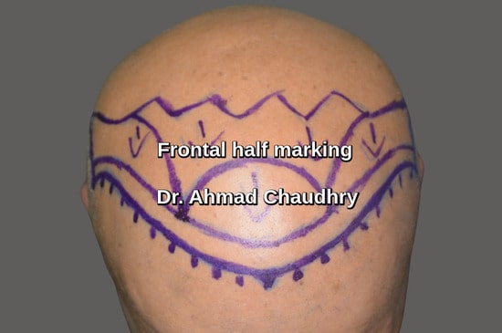 Frontal half baldness marking