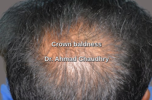 Crown baldness before