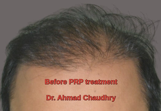 PRP hair treatment Lahore Pakistan