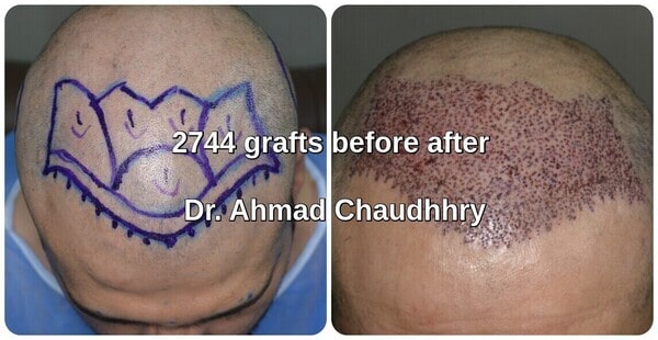 Before after hair plantation Lahore