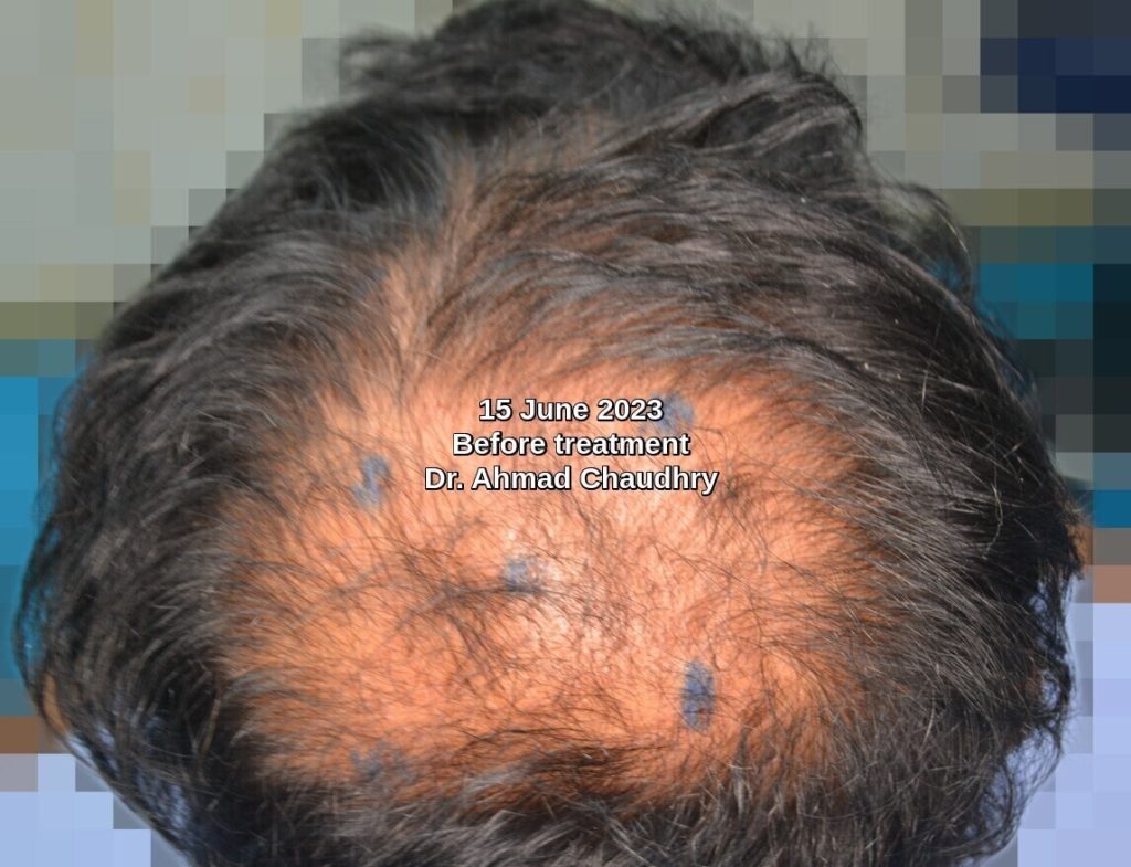 Before PRP treatment hair loss