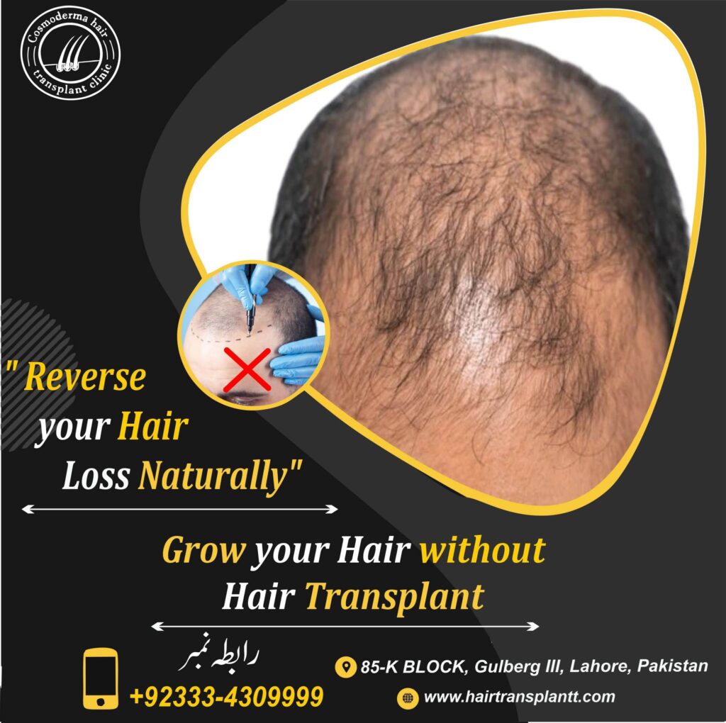 Hair regrowth without hair transplant