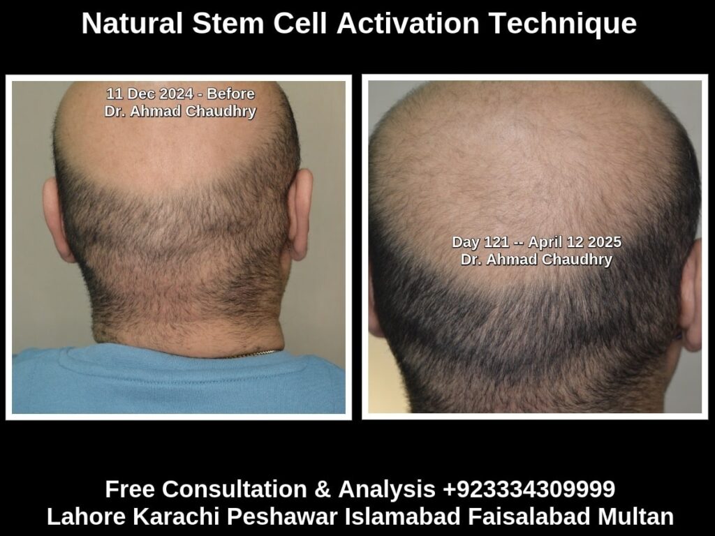 Hair regrowth treatment Muscat Oman patient result Hair regrowth treatment Muscat Oman patient result