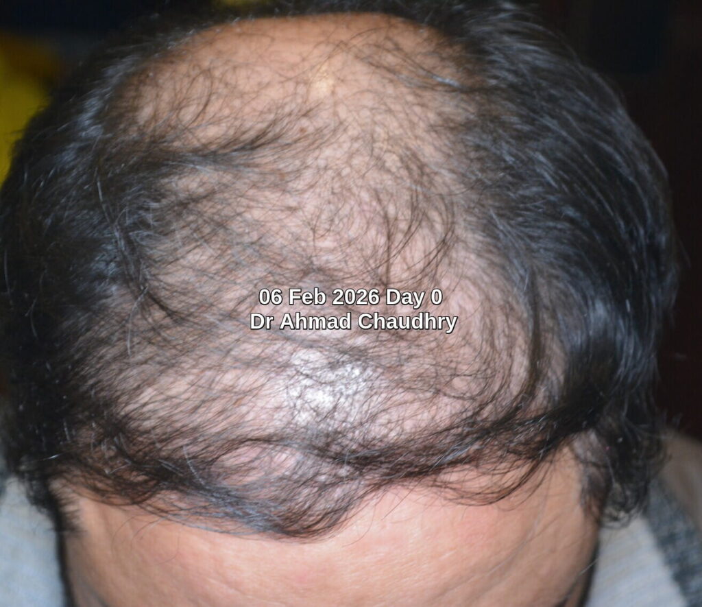 Before Hair Regrowth Treatment