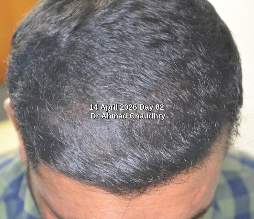 Dormant follicles reactivation results Pakistan