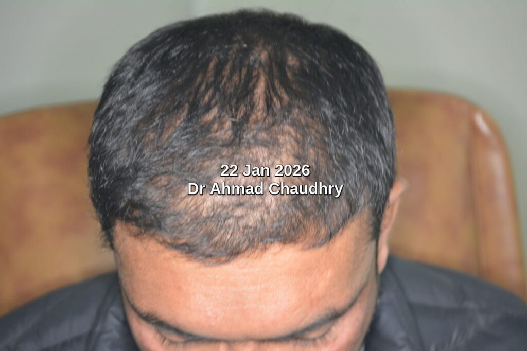 Failed hair transplant treatment