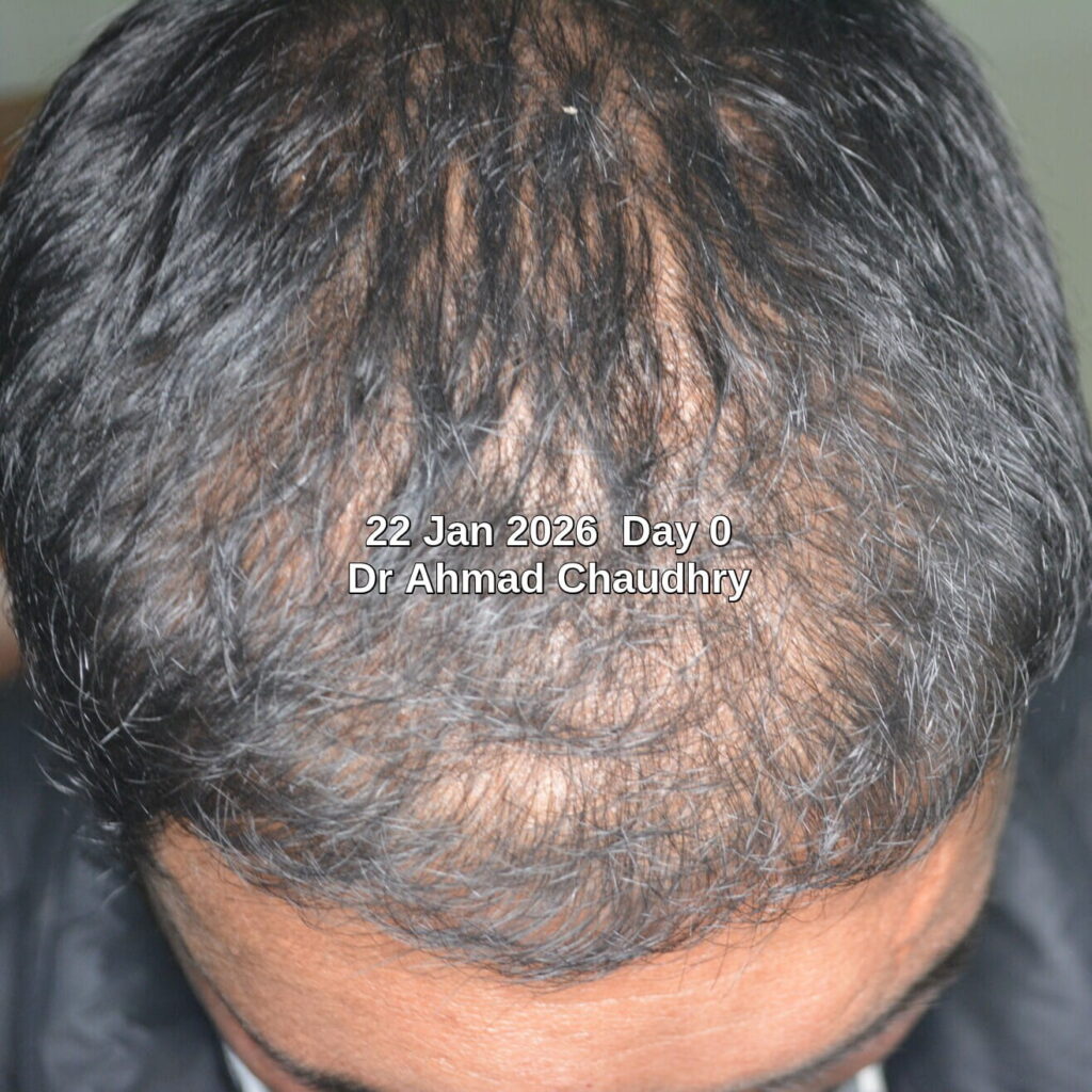 Hair thinning treatment stem cells activation before