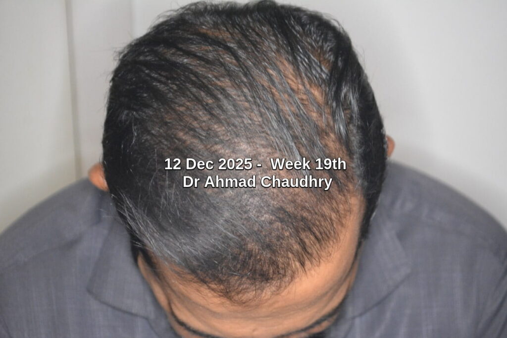 How to improve transplanted hair density few years later