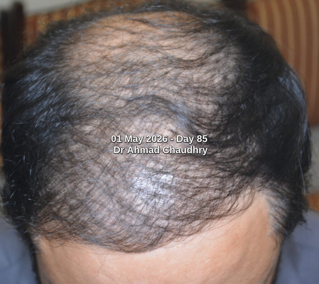 Single Exosomes treatment Results Pakistan