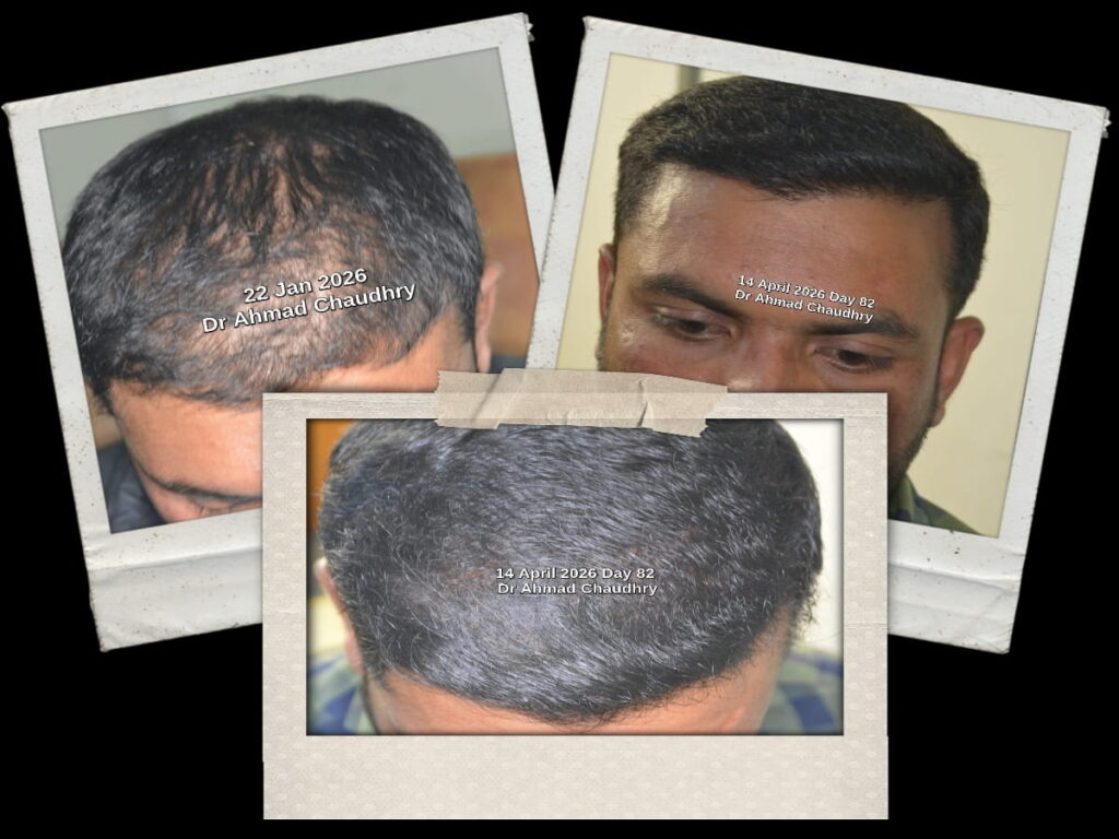 Stem Cells treatment hair growth before after results Pakistan