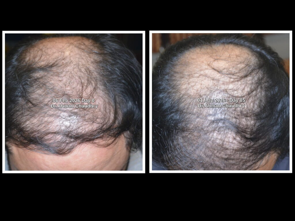 Topical Finasteride treatment results Pakistan Topical Finasteride treatment results Pakistan