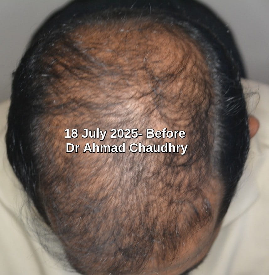 Transplanted hair fall 3 year after surgery
