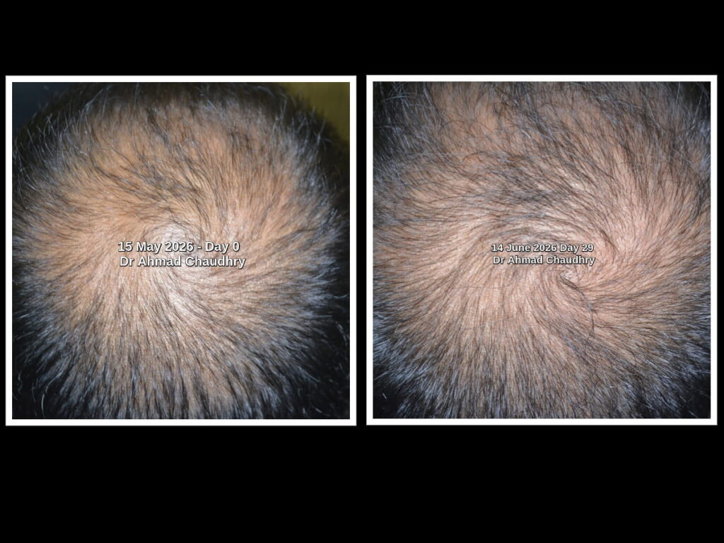 Before after Exosomes hair growth results Lahore Karachi Before after Exosomes hair growth results Lahore Karachi