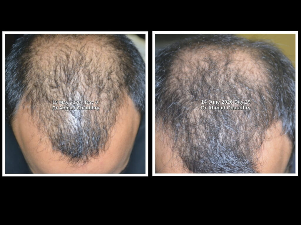 Best exosomes hair growth treatment Pakistan results Best exosomes hair growth treatment Pakistan results