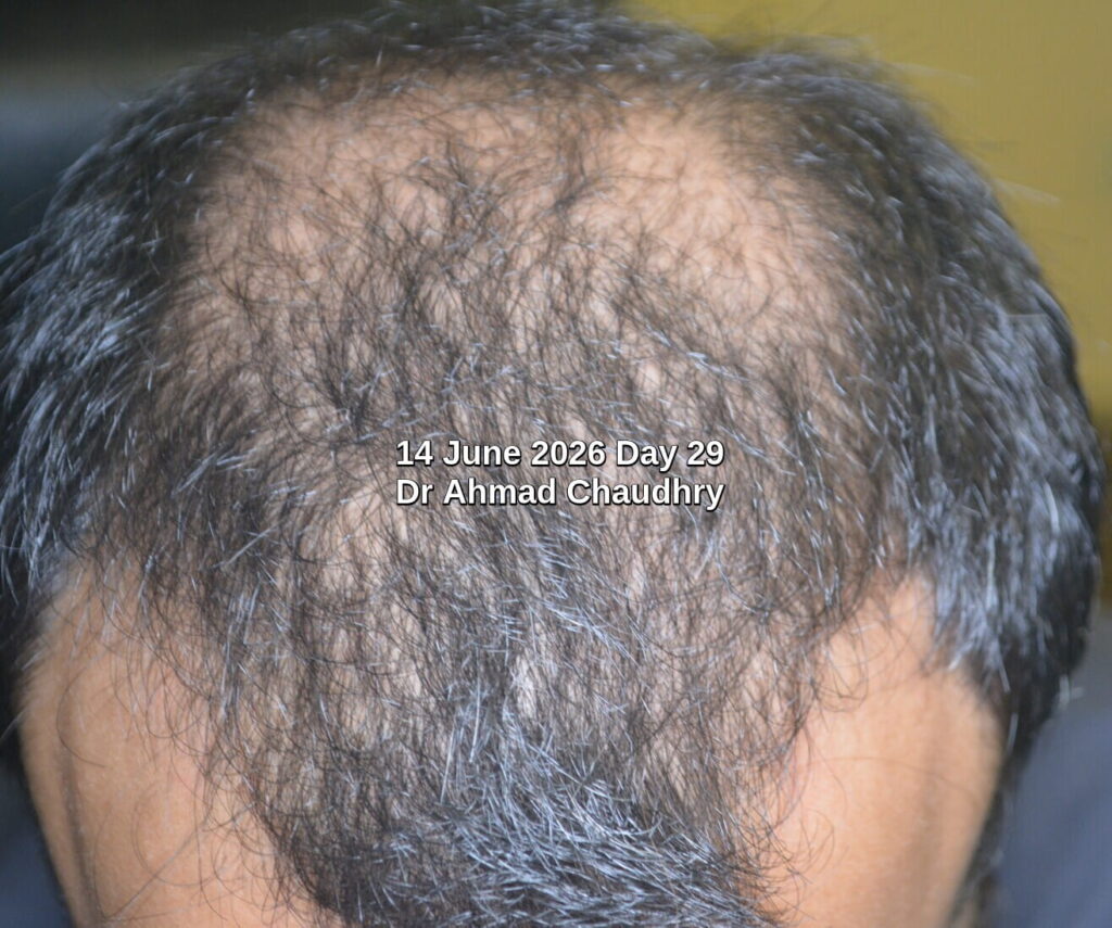 Best hair growth treatment Pakistan Best hair growth treatment Pakistan
