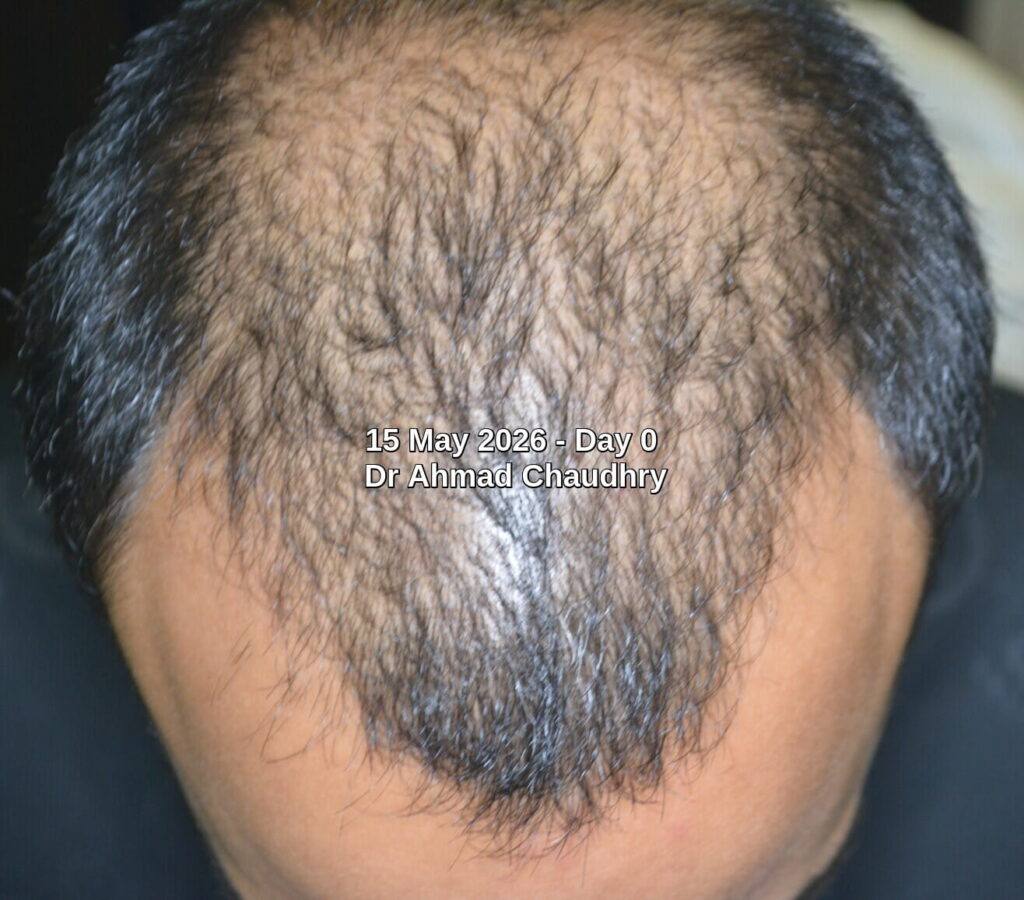 Best hair thinning solution Best hair thinning solution