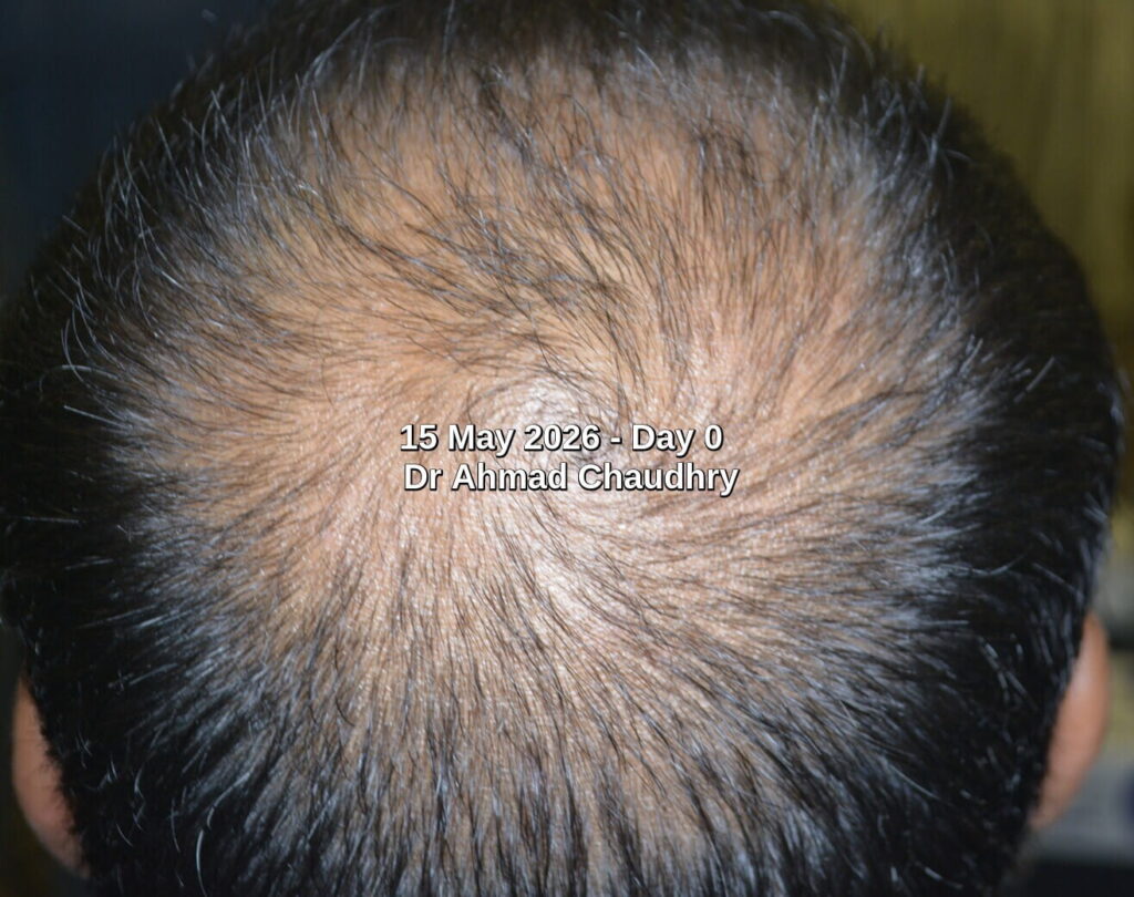 Hair loss assessment crown area Hair loss assessment crown area