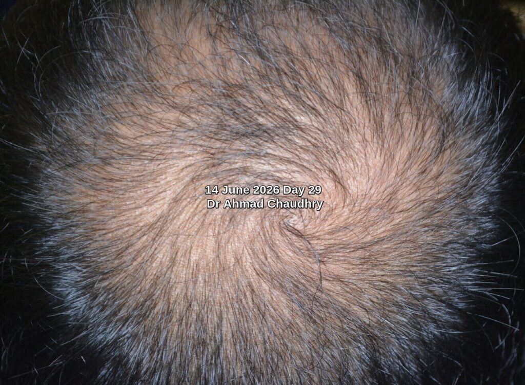 Hair restoration crown area Exosomes Pakistan Hair restoration crown area Exosomes Pakistan