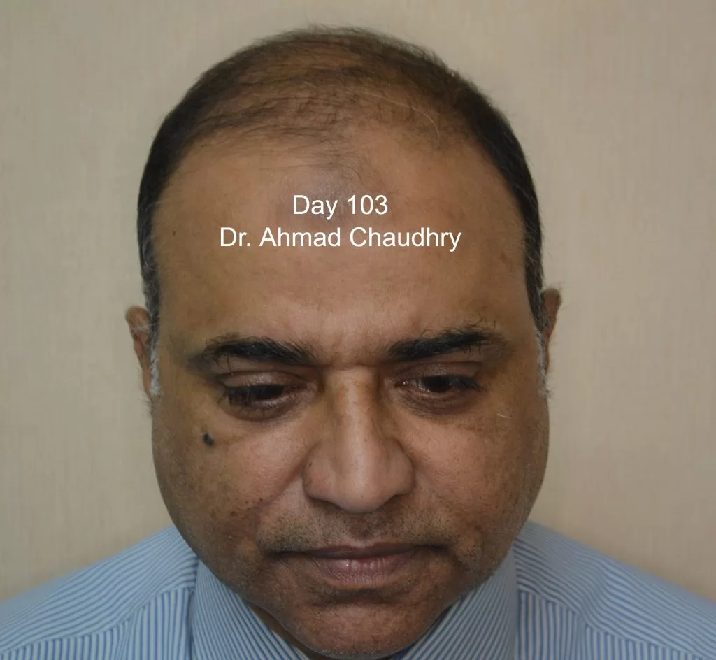 3.5 months later progress stem cells treatment