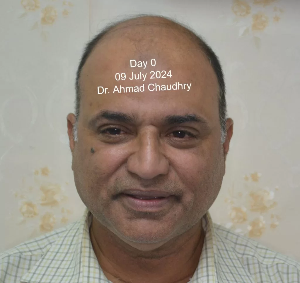 Advanced level baldness treatment Pakistan