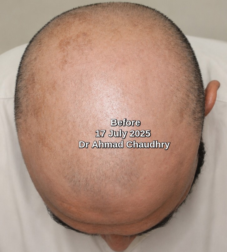 Diffuse hair thinning before treatment