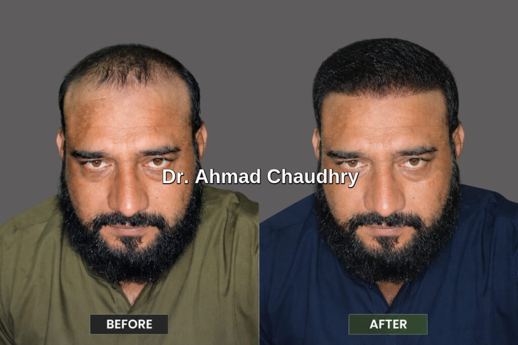 Exosomes hair regrowth results Lahore