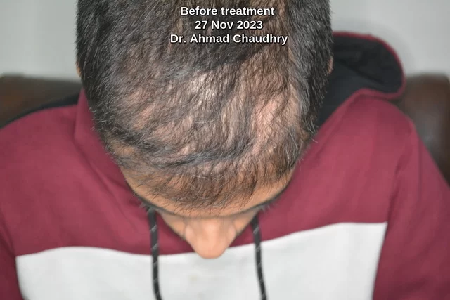 Hair thinning after hair transplant solution