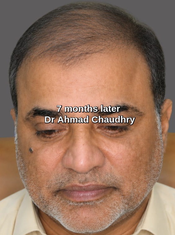 Hair thinning best solution