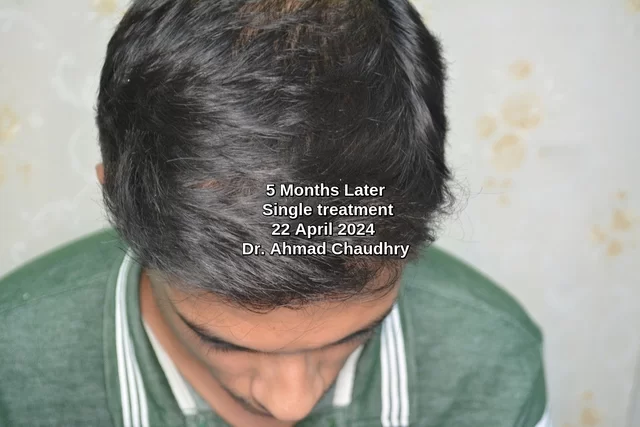 hair-regrowth-naturally-specialist-clinic-Lahore-result