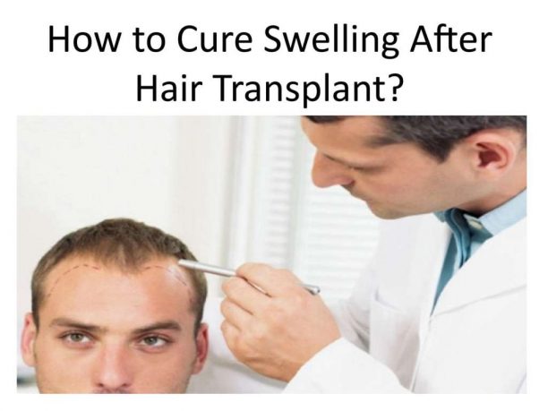 Swelling after hair transplant treatment
