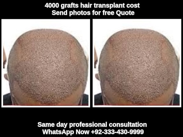FUT Fights Back  Hair Transplant Forum International