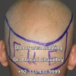 Fue donor area marking back sides